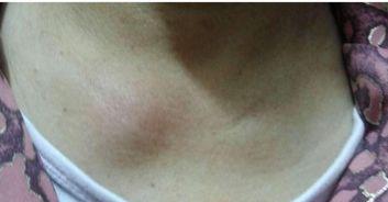 骨关节炎吃哈密瓜好吗,哈密瓜对缓解骨关节炎症状的益处探讨